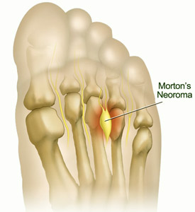 Example of corns - a common foot problem