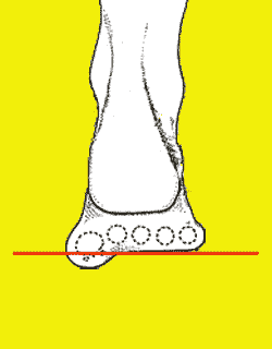 Plantar flexed 1st ray an example of a dropped joint